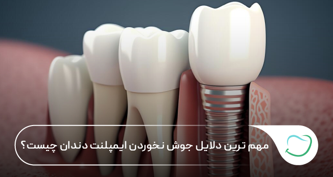 مهم ترین دلایل جوش نخوردن ایمپلنت دندان چیست؟ 🦷💗 مهم ترین دلایل جوش نخوردن ایمپلنت دندان چیست؟ 🦷💗