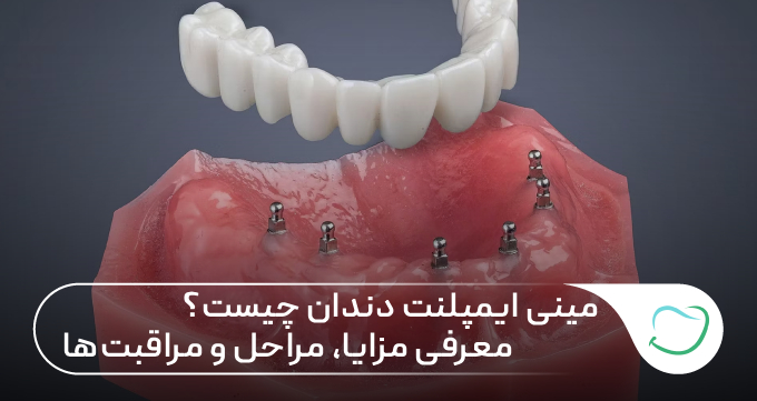 مینی ایمپلنت دندان چیست؟ معرفی مزایا، مراحل و مراقبتها 🦷✅ مینی ایمپلنت دندان چیست؟ معرفی مزایا، مراحل و مراقبتها 🦷✅