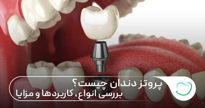 پروتز دندان چیست؟ بررسی انواع، کاربردها و مزایا 🦷✅ پروتز دندان چیست؟ بررسی انواع، کاربردها و مزایا 🦷✅