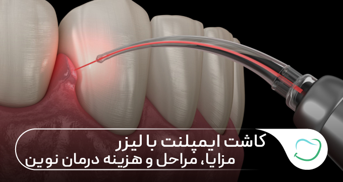 کاشت ایمپلنت با لیزر؛ مزایا، مراحل و هزینه درمان نوین 🦷✅ کاشت ایمپلنت با لیزر؛ مزایا، مراحل و هزینه درمان نوین 🦷✅