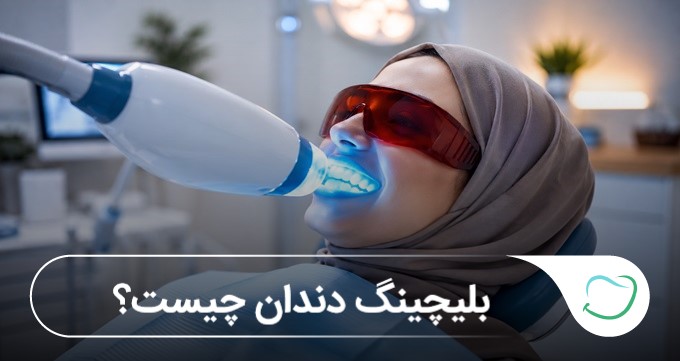 بلیچینگ دندان چیست؟ 🦷【آپدیتسال1405】 بلیچینگ دندان چیست؟ 🦷【آپدیتسال1405】