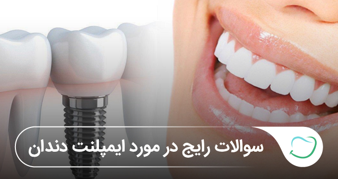 ۱۵ سؤال رایج در مورد ایمپلنت 🦷✅ ۱۵ سؤال رایج در مورد ایمپلنت 🦷✅