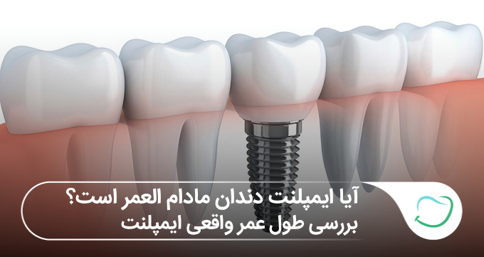 آیا ایمپلنت دندان مادامالعمر است؟ بررسی طول عمر واقعی ایمپلنت🦷 آیا ایمپلنت دندان مادامالعمر است؟ بررسی طول عمر واقعی ایمپلنت🦷