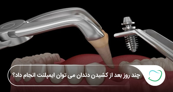 چند روز بعد از کشیدن دندان میتوان ایمپلنت انجام داد؟🦷⭐ چند روز بعد از کشیدن دندان میتوان ایمپلنت انجام داد؟🦷⭐