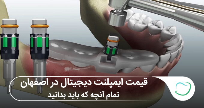 قیمت ایمپلنت دیجیتال در اصفهان: تمام آنچه که باید بدانید!🦷⭐ قیمت ایمپلنت دیجیتال در اصفهان: تمام آنچه که باید بدانید!🦷⭐