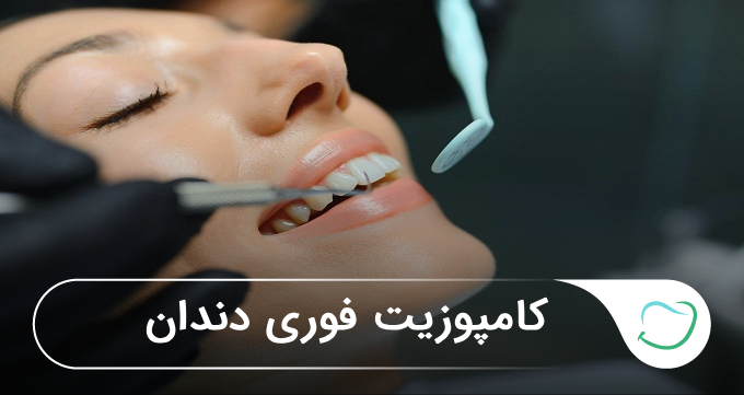 کامپوزیت فوری دندان🦷【سال1405】❤️ کامپوزیت فوری دندان🦷【سال1405】❤️
