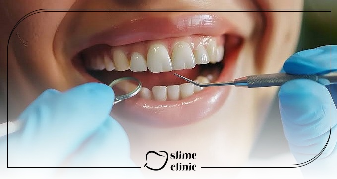 چرا هزینه کامپوزیت اقساطی برای همه یکسان نیست؟